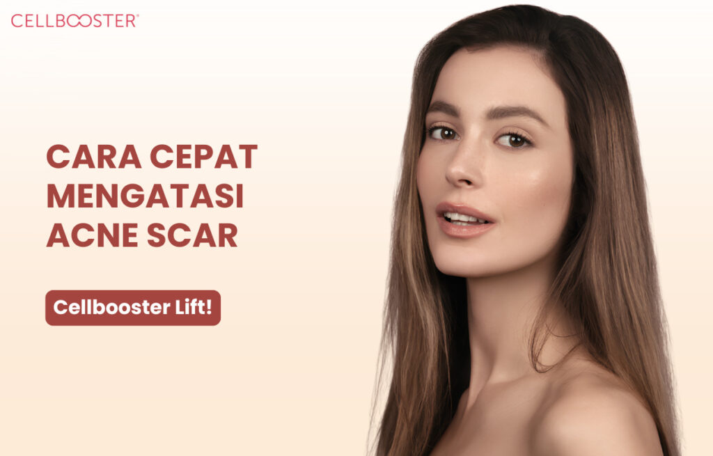acne scar adalah