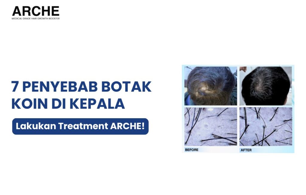 penyebab botak koin di kepala
