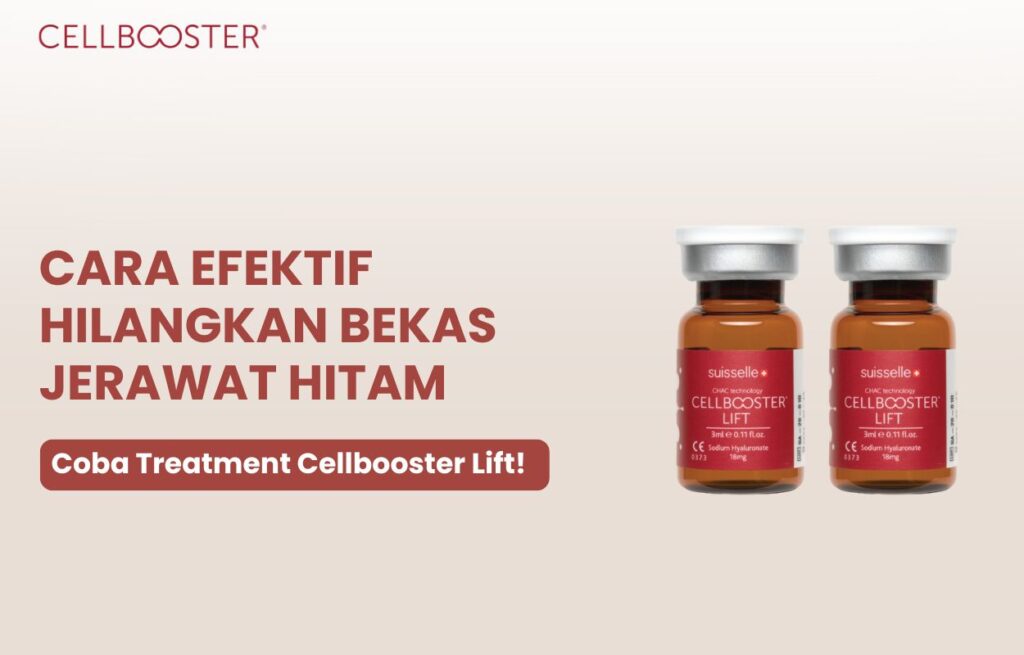 Menghilangkan bekas jerawat hitam