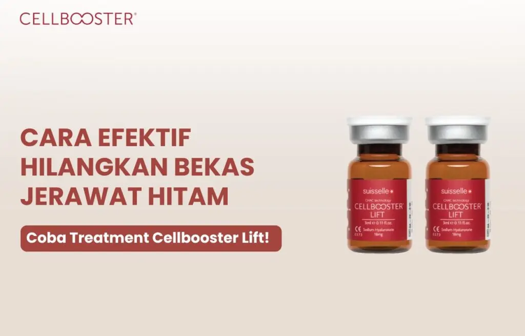 Menghilangkan bekas jerawat hitam