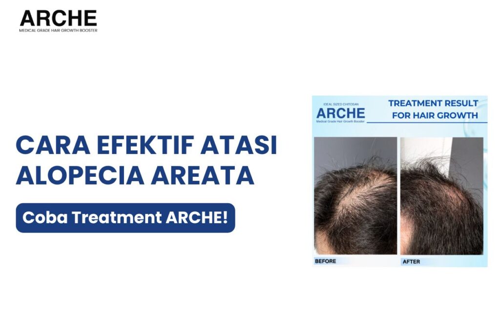 alopecia areata pada wanita​