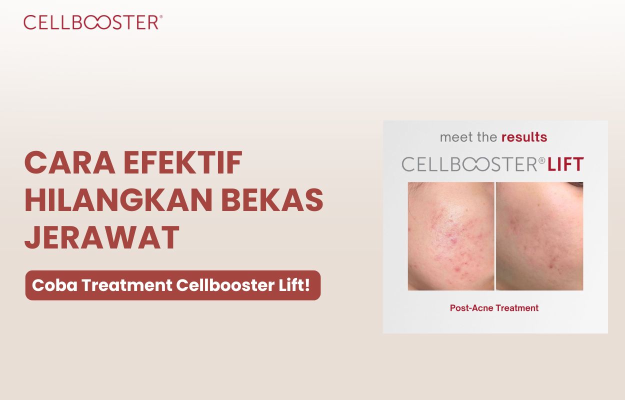 bagaimana menghilangkan bekas jerawat
