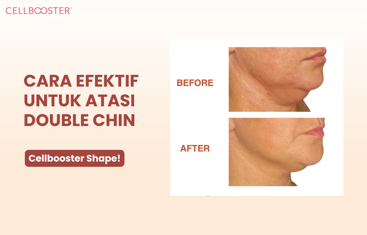 Penyebab Double Chin dan Cara Efektif Mengatasinya