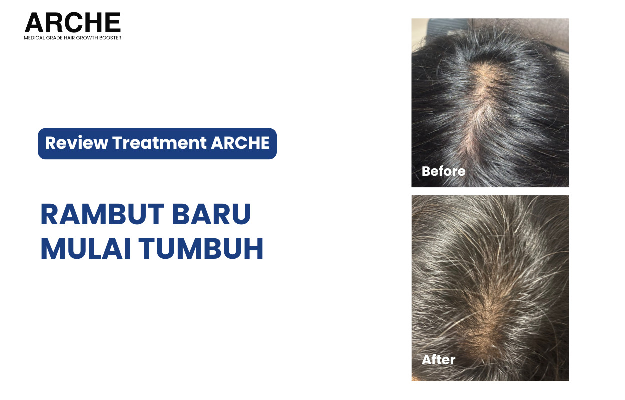 Perubahan Signifikan Setelah Enam Sesi Perawatan ARCHE untuk Rambut Rontok