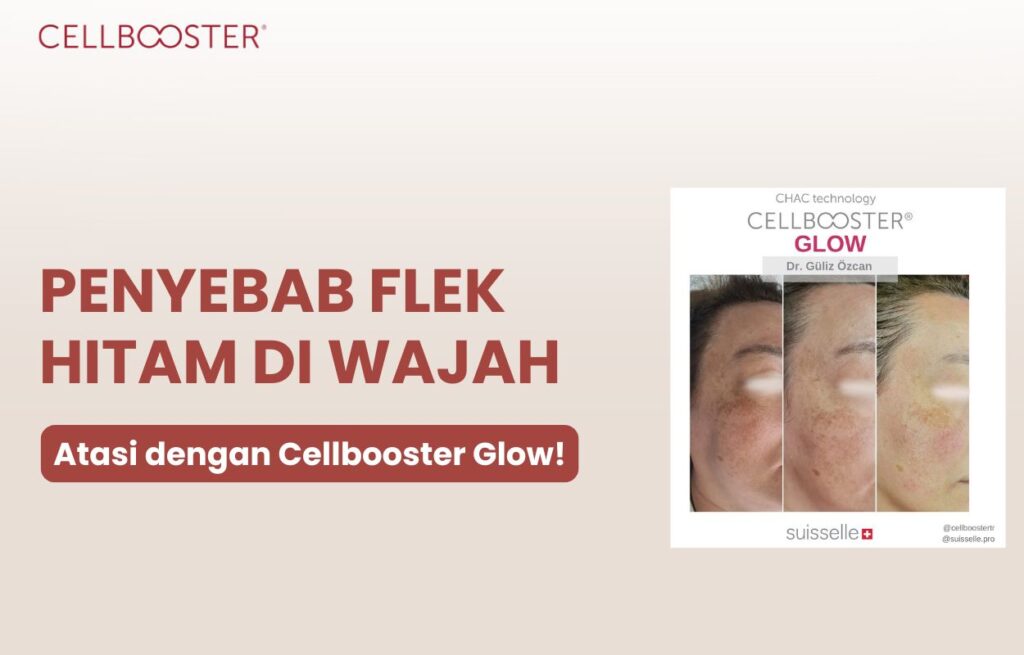 Penyebab flek hitam di wajah