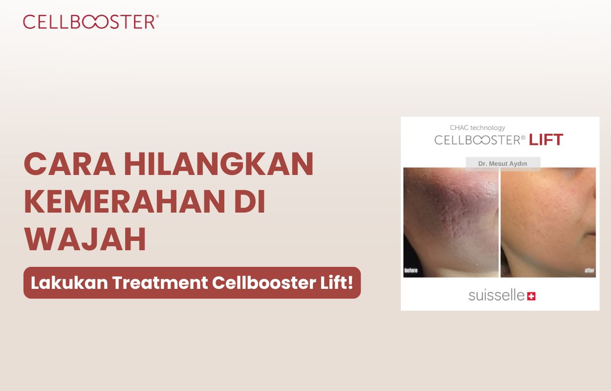 cara menghilangkan merah di wajah