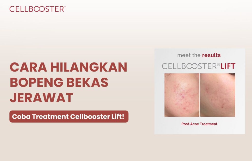 bagaimana cara menghilangkan bopeng bekas jerawat