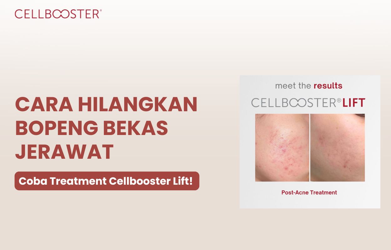 bagaimana cara menghilangkan bopeng bekas jerawat