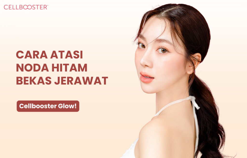 Noda Hitam Bekas Jerawat