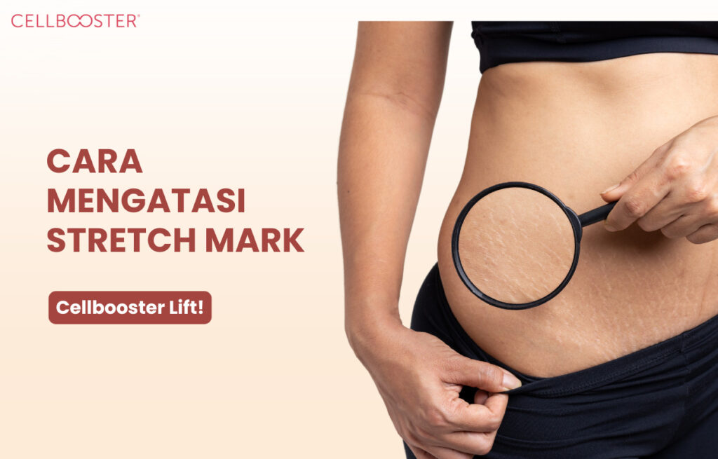Apa Itu Stretch Mark