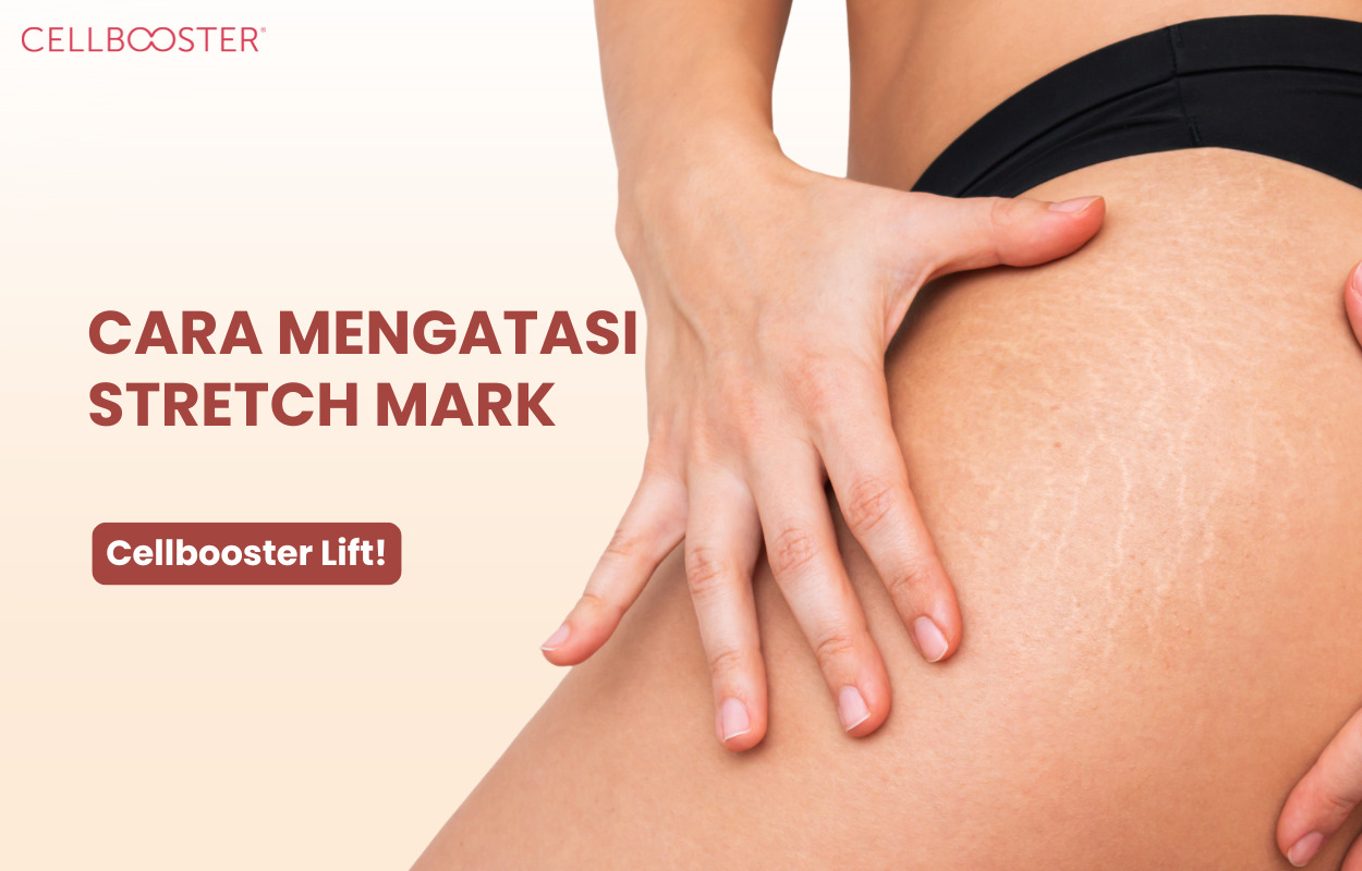 Apa Penyebab Stretch Mark
