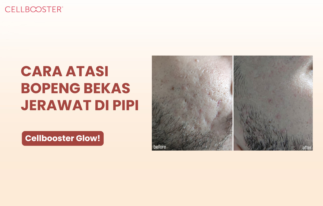 Cara Menghilangkan Bopeng di Pipi