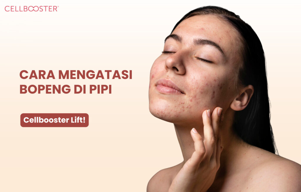 Cara Mengatasi Bopeng di Pipi
