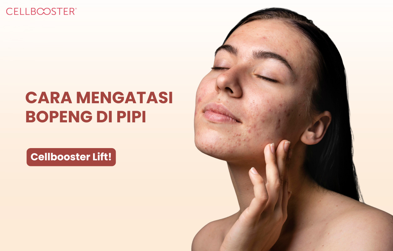 Cara Mengatasi Bopeng di Pipi