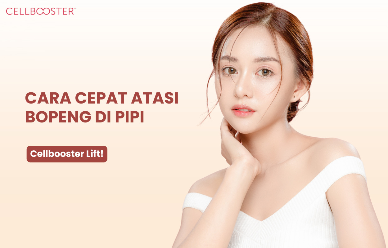 Cara Menghilangkan Bopeng Bekas Jerawat di Pipi