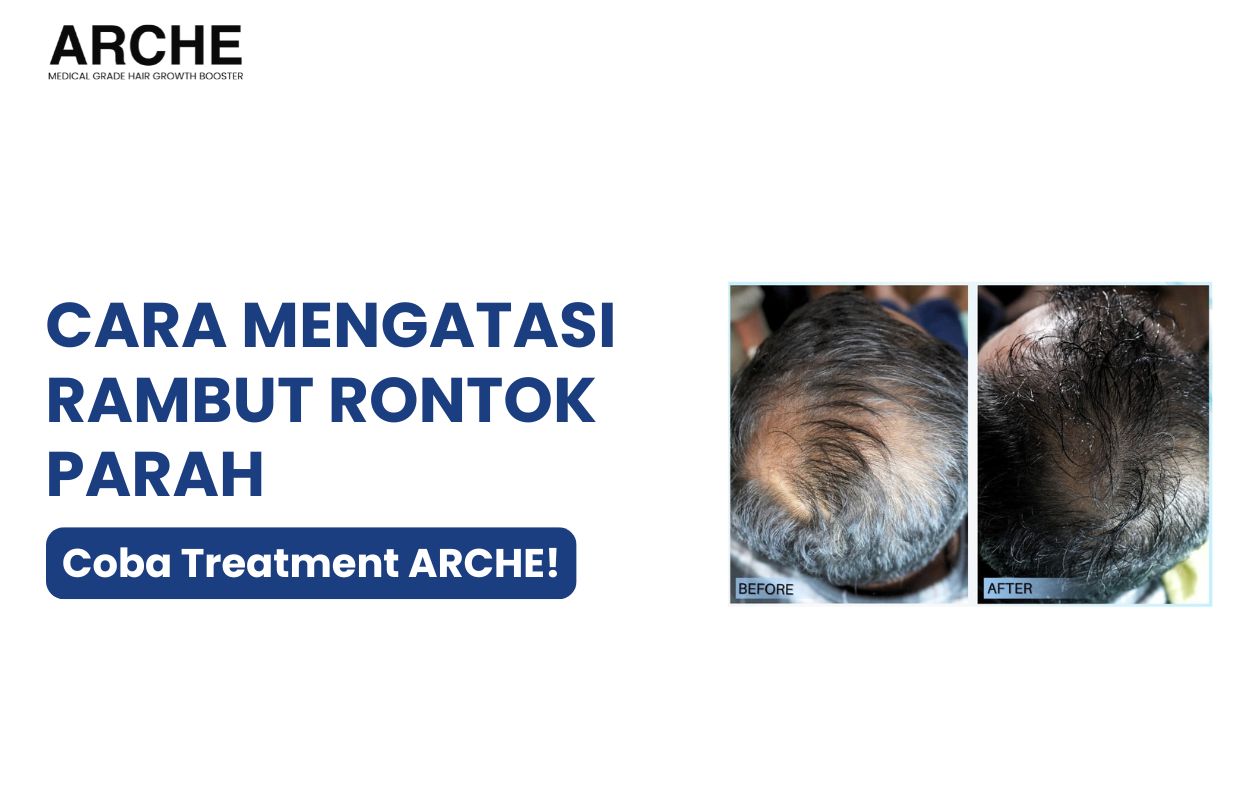 mengobati rambut rontok parah secara alami