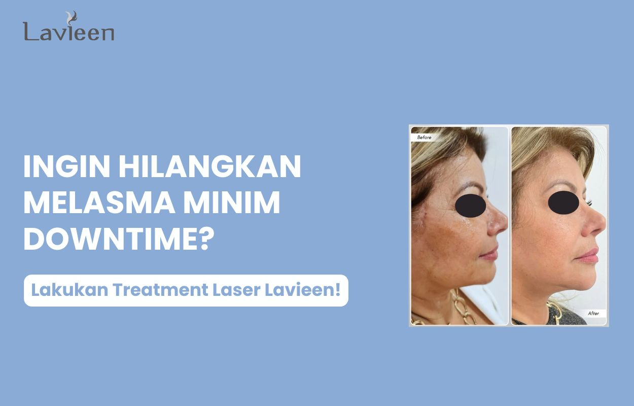 perawatan melasma