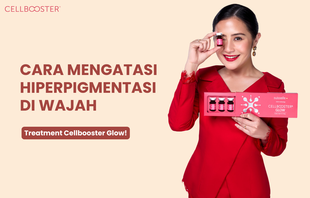 Hiperpigmentasi Wajah