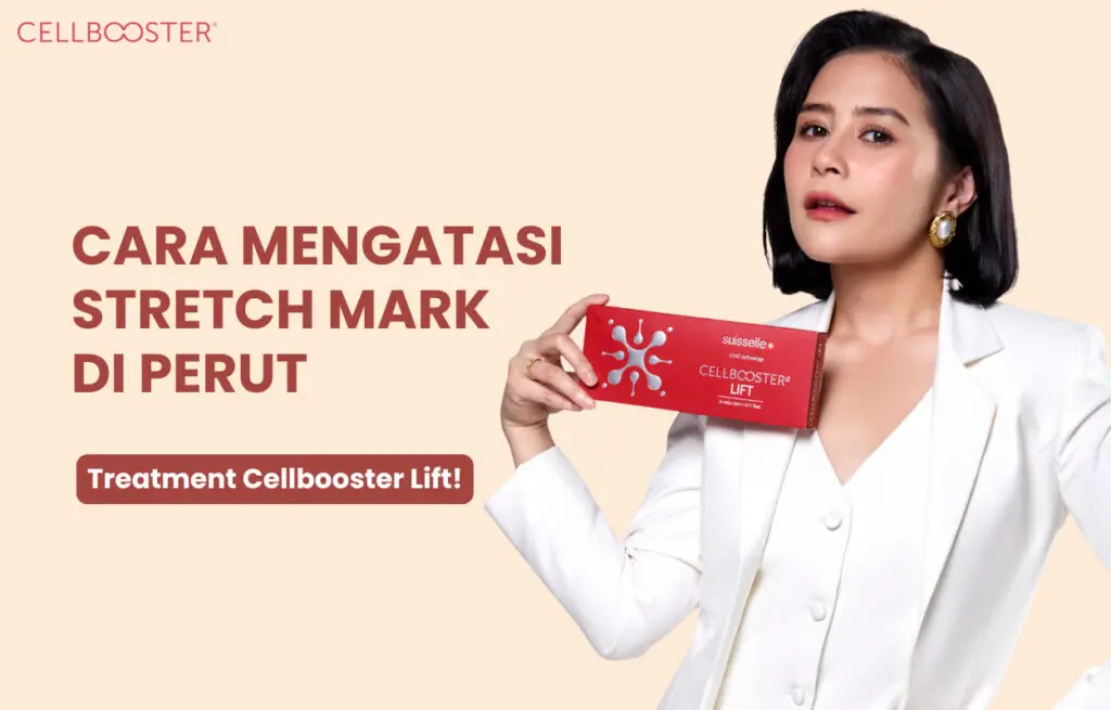 Stretch Mark Perut