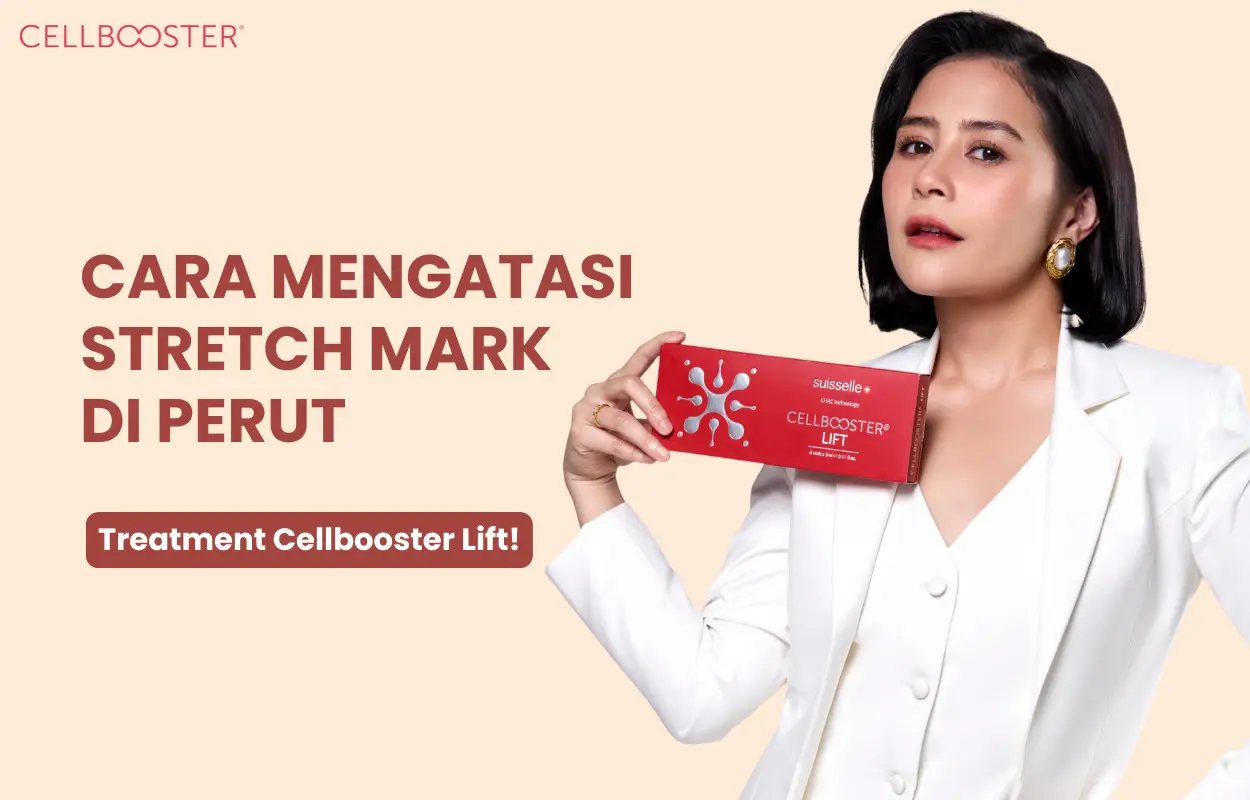Stretch Mark Perut