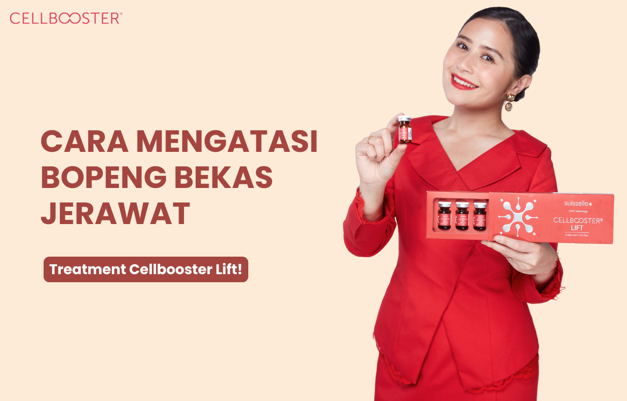 Cara Menghilangkan Bopeng Bekas Jerawat di Wajah