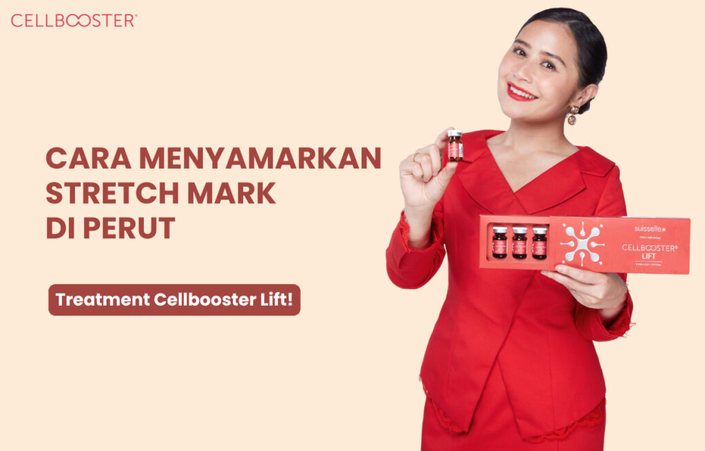 Perut Stretch Mark