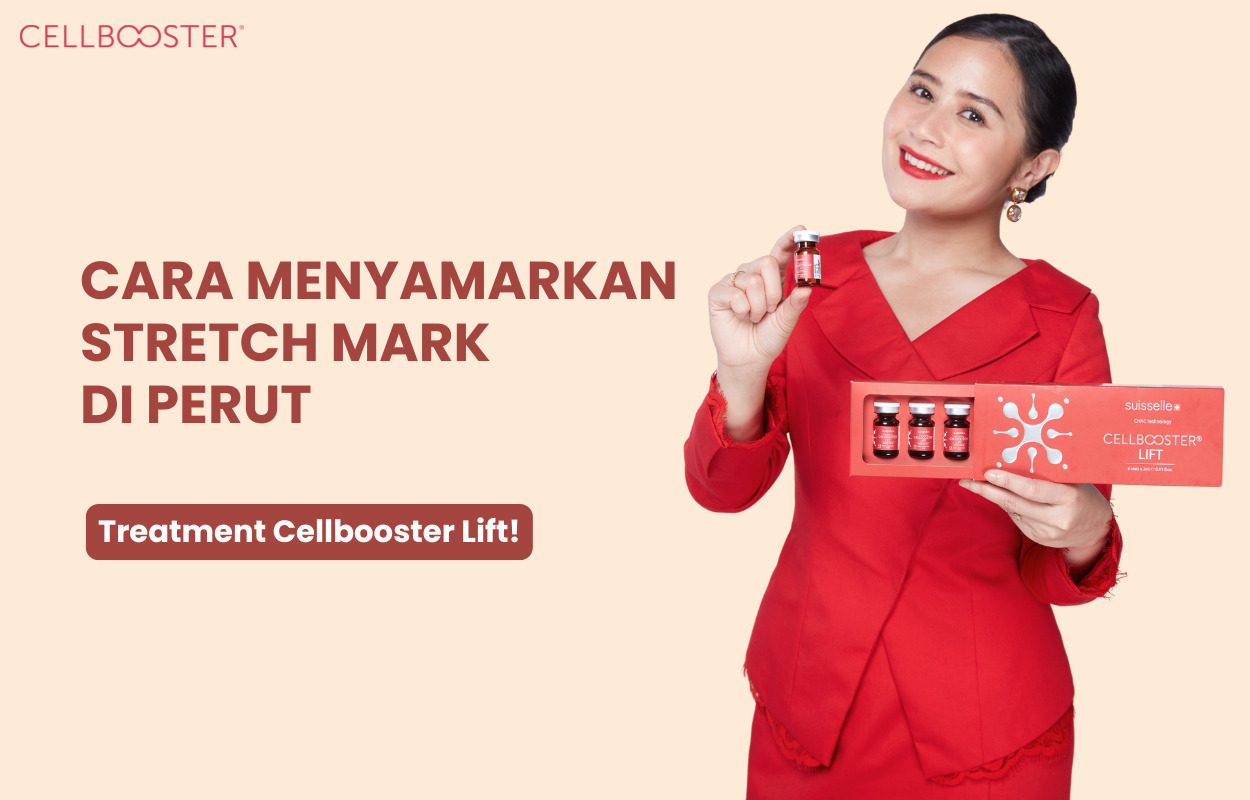 Perut Stretch Mark