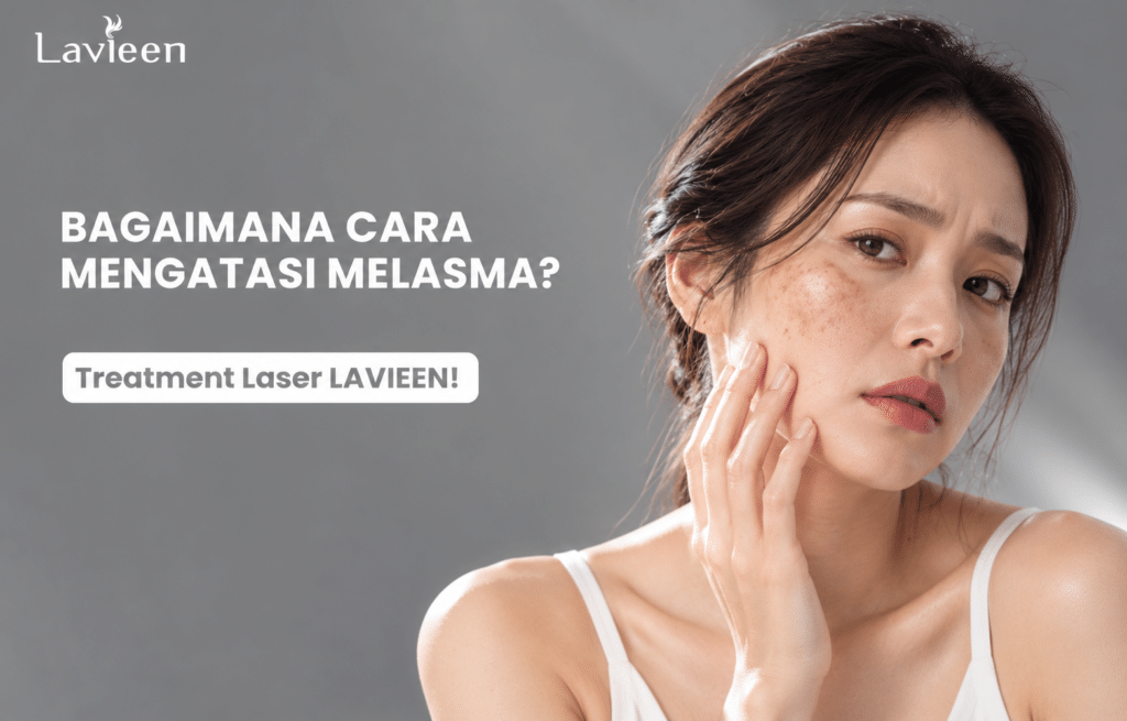 treatment melasma