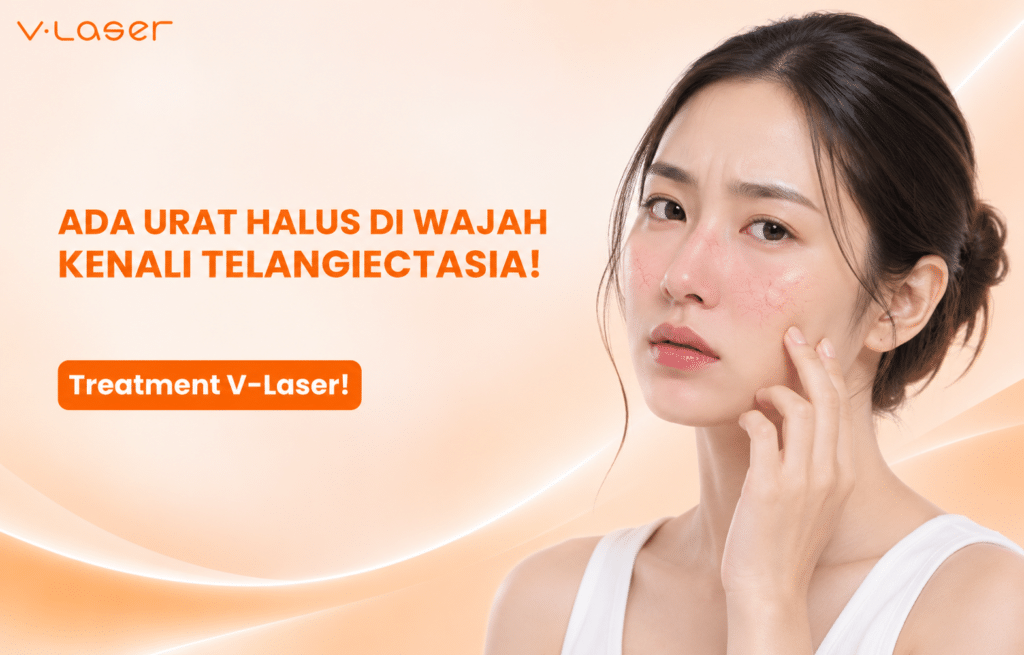 Telangiectasia Wajah